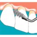 Sonicflex clean - набор насадок и щетки Sono для профессиональной механической чистки зубов (снятия зубных отложений)