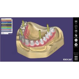 Exocad Implant Module - модуль для создания имплантов