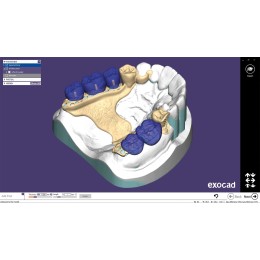 Exocad Partial Framework Module - модуль для создания бюгелей