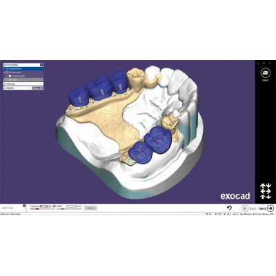 Exocad Partial Framework Module - модуль для создания бюгелей Exocad Partial Framework Module - модуль для создания бюгелей