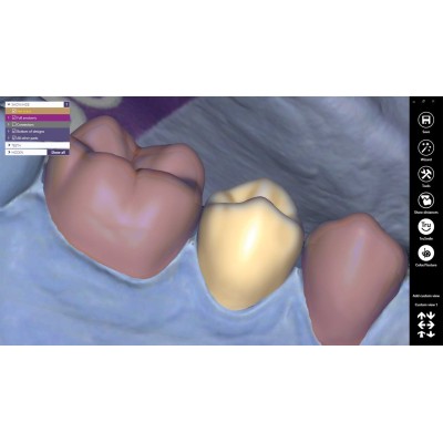 Exocad Provisional - модуль для создания временных конструкций Exocad Provisional - модуль для создания временных конструкций