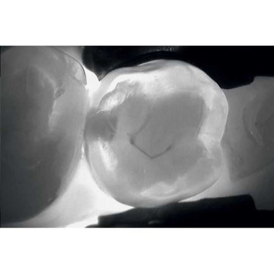 KaVo DIAGNOcam - прибор для диагностики кариозных поражений KaVo DIAGNOcam - прибор для диагностики кариозных поражений