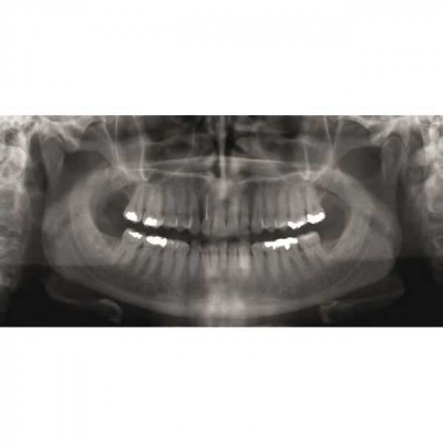 GENDEX GXDP-300 - цифровая панорамная рентгенодиагностическая система GENDEX GXDP-300 - цифровая панорамная рентгенодиагностическая система