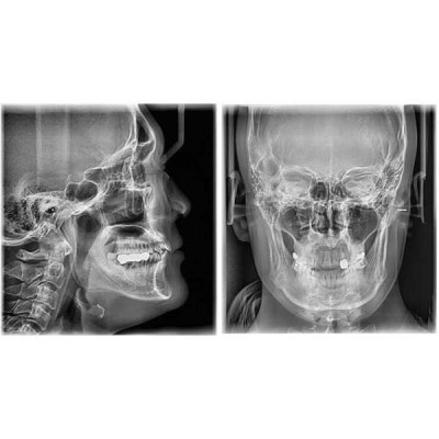 Pax-i 3D SC - панорамный аппарат и конусно-лучевой томограф с цефалостатом, FOV 10x8.5 см Pax-i 3D SC - панорамный аппарат и конусно-лучевой томограф с цефалостатом, FOV 10x8.5 см