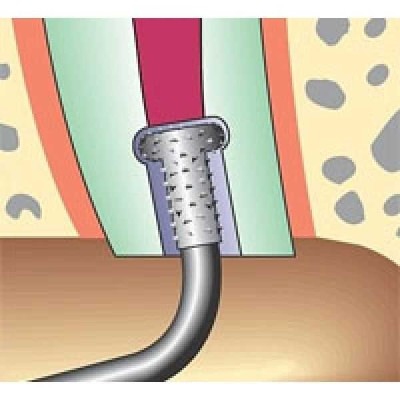 Sonicflex retro - набор алмазных насадок со штопферами для щадящего препарирования ретроградных полостей Sonicflex retro - набор алмазных насадок со штопферами для щадящего препарирования ретроградных полостей