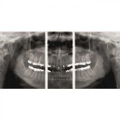 KaVo Pan eXam Plus 3D Ceph (2 датчика) - универсальный датчик Pan/Ceph для панорамной томографии, цефалостат, функция 3D-томографии 6x8 см KaVo Pan eXam Plus 3D Ceph (2 датчика) - универсальный датчик Pan/Ceph для панорамной томографии, цефалостат, функция 3D-томографии 6x8 см