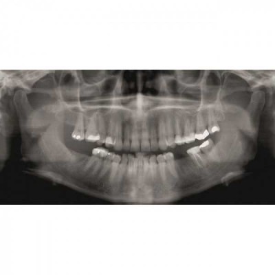 GENDEX GXDP-300 - цифровая панорамная рентгенодиагностическая система GENDEX GXDP-300 - цифровая панорамная рентгенодиагностическая система