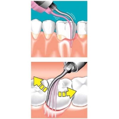 SONICflex paro - набор насадок для минимально инвазивной терапии пародонтита SONICflex paro - набор насадок для минимально инвазивной терапии пародонтита