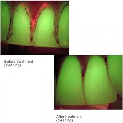 Spectra - оптический детектор кариеса Spectra - оптический детектор кариеса