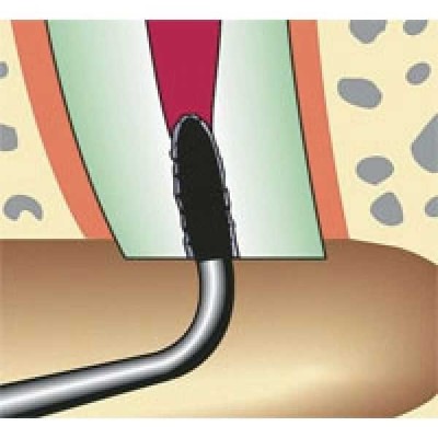 Sonicflex retro - набор алмазных насадок со штопферами для щадящего препарирования ретроградных полостей Sonicflex retro - набор алмазных насадок со штопферами для щадящего препарирования ретроградных полостей