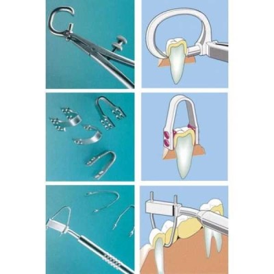 CORONAflex 2005 - наконечник для щадящего снятия коронок и мостов CORONAflex 2005 - наконечник для щадящего снятия коронок и мостов