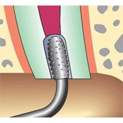 Sonicflex retro - набор алмазных насадок со штопферами для щадящего препарирования ретроградных полостей Sonicflex retro - набор алмазных насадок со штопферами для щадящего препарирования ретроградных полостей