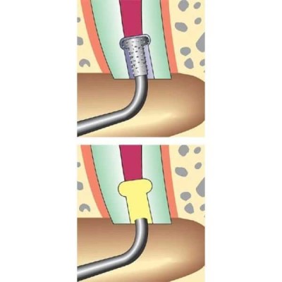 Sonicflex retro - набор алмазных насадок со штопферами для щадящего препарирования ретроградных полостей Sonicflex retro - набор алмазных насадок со штопферами для щадящего препарирования ретроградных полостей