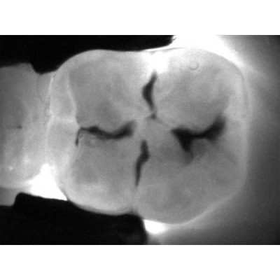 KaVo DIAGNOcam - прибор для диагностики кариозных поражений KaVo DIAGNOcam - прибор для диагностики кариозных поражений