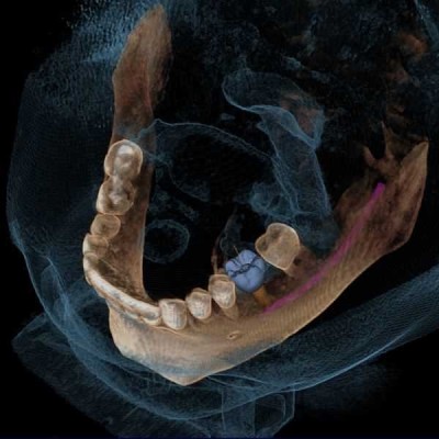 GALILEOS COMFORT PLUS - цифровое рентген устройство для получения высококачественных 3D-изображений всей зоны зубов GALILEOS COMFORT PLUS - цифровое рентген устройство для получения высококачественных 3D-изображений всей зоны зубов