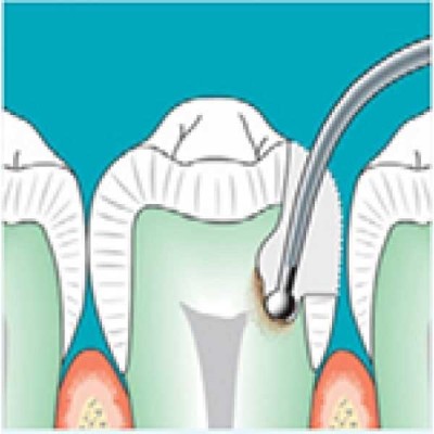 Sonicflex cariex D/TC - насадки для щадящей экскавации кариеса Sonicflex cariex D/TC - насадки для щадящей экскавации кариеса