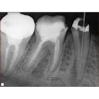 PORT-X II - портативный высокочастотный интраоральный рентгеновский аппарат PORT-X II - портативный высокочастотный интраоральный рентгеновский аппарат