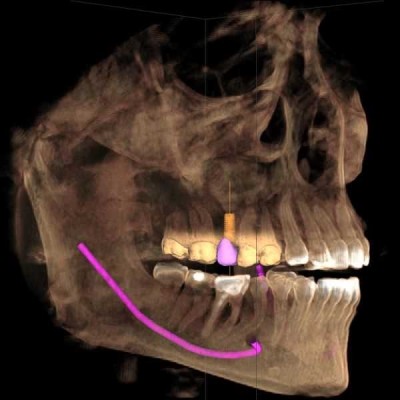 GALILEOS COMFORT PLUS - цифровое рентген устройство для получения высококачественных 3D-изображений всей зоны зубов GALILEOS COMFORT PLUS - цифровое рентген устройство для получения высококачественных 3D-изображений всей зоны зубов