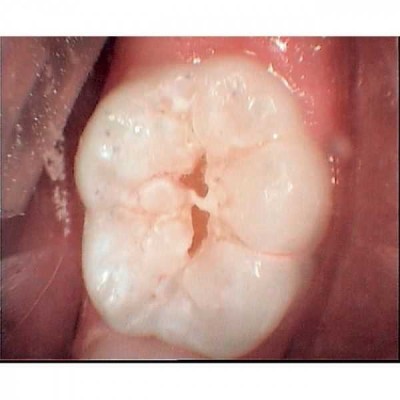 RONDOflex plus 360 - воздушно-абразивный наконечник RONDOflex plus 360 - воздушно-абразивный наконечник