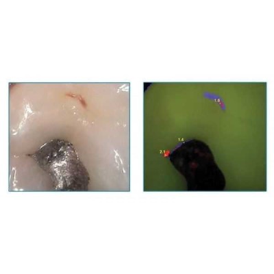 Spectra - оптический детектор кариеса Spectra - оптический детектор кариеса