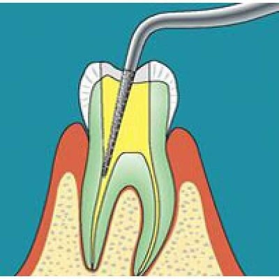 Sonicflex endo - набор алмазных или частично алмазных насадок для нахождения входа в корневой канал, для препарирования полости пульпы и для проведения ревизий Sonicflex endo - набор алмазных или частично алмазных насадок для нахождения входа в корневой канал, для препарирования полости пульпы и для проведения ревизий