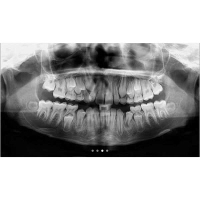 Cranex Novus e NEW - цифровой ортопантомограф с максимальным анодным напряжением 70кВ Cranex Novus e NEW - цифровой ортопантомограф с максимальным анодным напряжением 70кВ