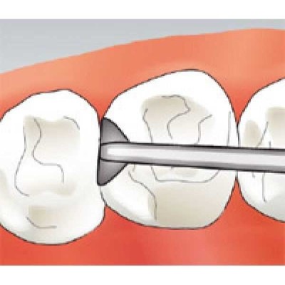 Sonicflex prep gold/ceram - насадки с односторонним алмазным напылением и особым углом изгиба для апроксимальной финишной обработки адгезивных вкладок Sonicflex prep gold/ceram - насадки с односторонним алмазным напылением и особым углом изгиба для апроксимальной финишной обработки адгезивных вкладок
