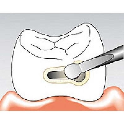Sonicflex micro - набор насадок для препарирования малых полостей и скашивания краев эмали Sonicflex micro - набор насадок для препарирования малых полостей и скашивания краев эмали