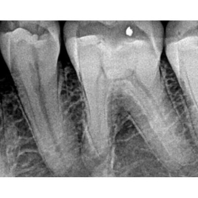 Kodak RVG 5200 - радиовизиограф, 16 пар линий/мм Kodak RVG 5200 - радиовизиограф, 16 пар линий/мм