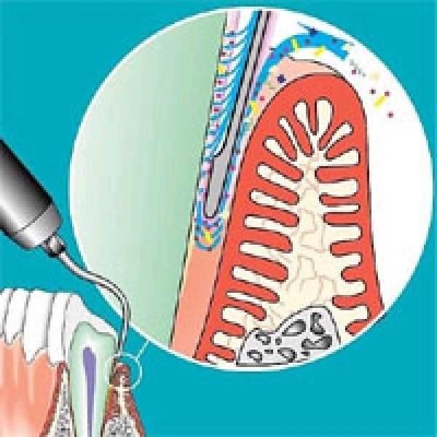 SONICflex paro - набор насадок для минимально инвазивной терапии пародонтита SONICflex paro - набор насадок для минимально инвазивной терапии пародонтита