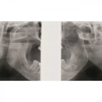 KaVo Pan eXam Plus 3D - датчик для панорамной рентгенодиагностики, функция 3D-томографии 6x8 см, возможность дооснащения модулем цефалостата KaVo Pan eXam Plus 3D - датчик для панорамной рентгенодиагностики, функция 3D-томографии 6x8 см, возможность дооснащения модулем цефалостата