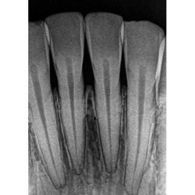 Kodak RVG 5200 - радиовизиограф, 16 пар линий/мм Kodak RVG 5200 - радиовизиограф, 16 пар линий/мм
