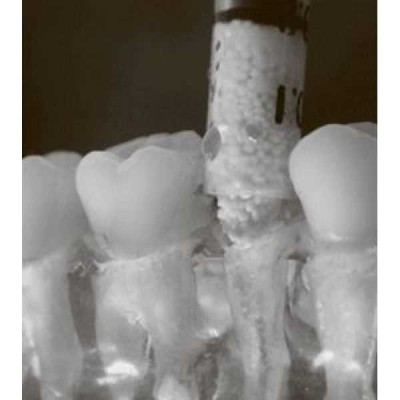 Easy Graft CRYSTAL 0,400 мл - синтетический костнозамещающий материал Easy Graft CRYSTAL 0,400 мл - синтетический костнозамещающий материал