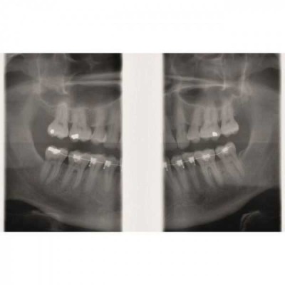 GENDEX GXDP-300 - цифровая панорамная рентгенодиагностическая система GENDEX GXDP-300 - цифровая панорамная рентгенодиагностическая система