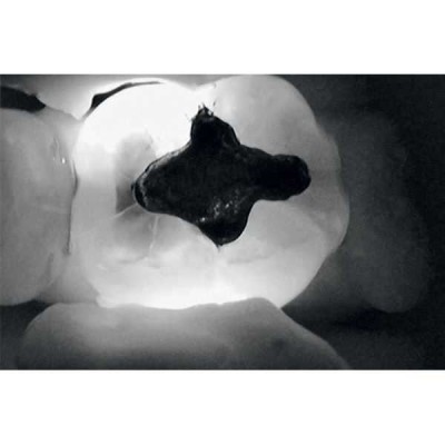 KaVo DIAGNOcam - прибор для диагностики кариозных поражений KaVo DIAGNOcam - прибор для диагностики кариозных поражений