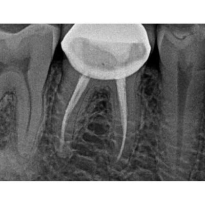 Kodak RVG 5200 - радиовизиограф, 16 пар линий/мм Kodak RVG 5200 - радиовизиограф, 16 пар линий/мм