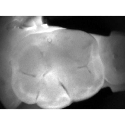 KaVo DIAGNOcam - прибор для диагностики кариозных поражений KaVo DIAGNOcam - прибор для диагностики кариозных поражений