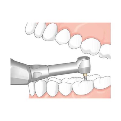 Endo-Mate TC2 MPA - беспроводной эндодонтический микромотор с возможностью быстрого подключения апекслокатора Endo-Mate TC2 MPA - беспроводной эндодонтический микромотор с возможностью быстрого подключения апекслокатора