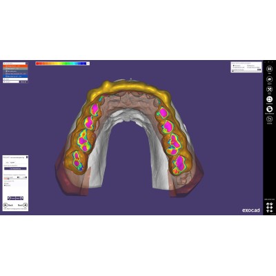 Exocad Bite Splint Module - модуль для создания терапевтических капп Exocad Bite Splint Module - модуль для создания терапевтических капп