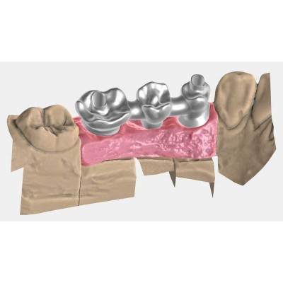 Exocad Implant Module - модуль для создания имплантов Exocad Implant Module - модуль для создания имплантов