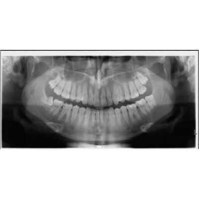Cranex Novus e NEW - цифровой ортопантомограф с максимальным анодным напряжением 70кВ Cranex Novus e NEW - цифровой ортопантомограф с максимальным анодным напряжением 70кВ