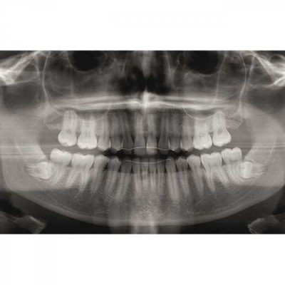 KaVo Pan eXam Plus 3D - датчик для панорамной рентгенодиагностики, функция 3D-томографии 6x8 см, возможность дооснащения модулем цефалостата KaVo Pan eXam Plus 3D - датчик для панорамной рентгенодиагностики, функция 3D-томографии 6x8 см, возможность дооснащения модулем цефалостата