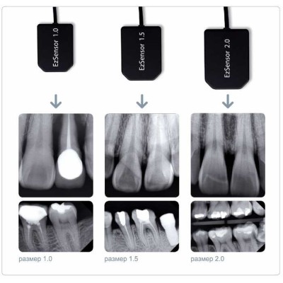 Комплект Rextar X и EzSensor - высокочастотный портативный дентальный рентген с визиографом Комплект Rextar X и EzSensor - высокочастотный портативный дентальный рентген с визиографом
