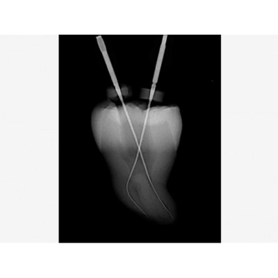 Tri Auto ZX2 - беспроводной эндодонтический мотор со встроенным апекслокатором Tri Auto ZX2 - беспроводной эндодонтический мотор со встроенным апекслокатором