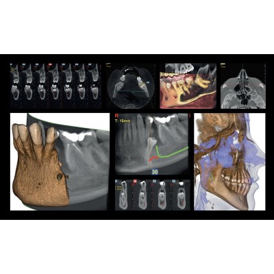 Дентальный томограф Hyperion X9 Pro с цефалостатом (13x16) (16х18 опция) Дентальный томограф Hyperion X9 Pro с цефалостатом (13x16) (16х18 опция)