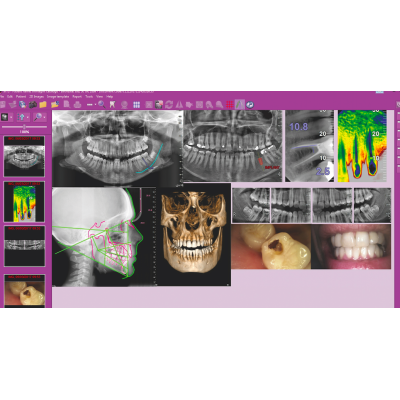 Дентальный томограф Hyperion X9 Pro с цефалостатом (13x16) (16х18 опция) Дентальный томограф Hyperion X9 Pro с цефалостатом (13x16) (16х18 опция)