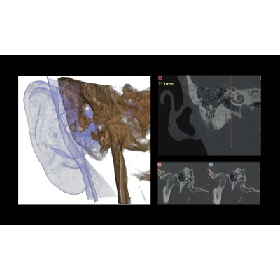 Дентальный томограф Hyperion X9 Pro с цефалостатом (13x16) (16х18 опция) Дентальный томограф Hyperion X9 Pro с цефалостатом (13x16) (16х18 опция)